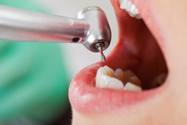 Best Emergency Dental Care for Broken or Chipped Teeth in Montebello, NY